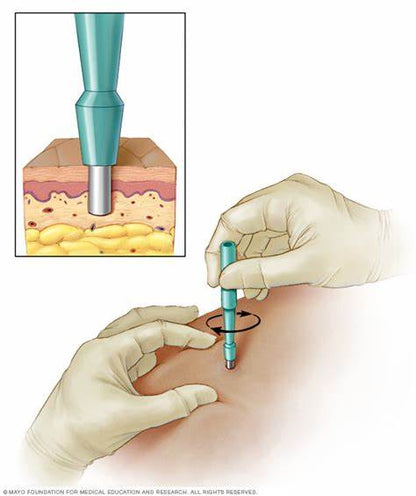Netcare Disposable Skin Biopsy Punch | Sterile | Sharp and precise (6.0mm) | (Pack of 5)